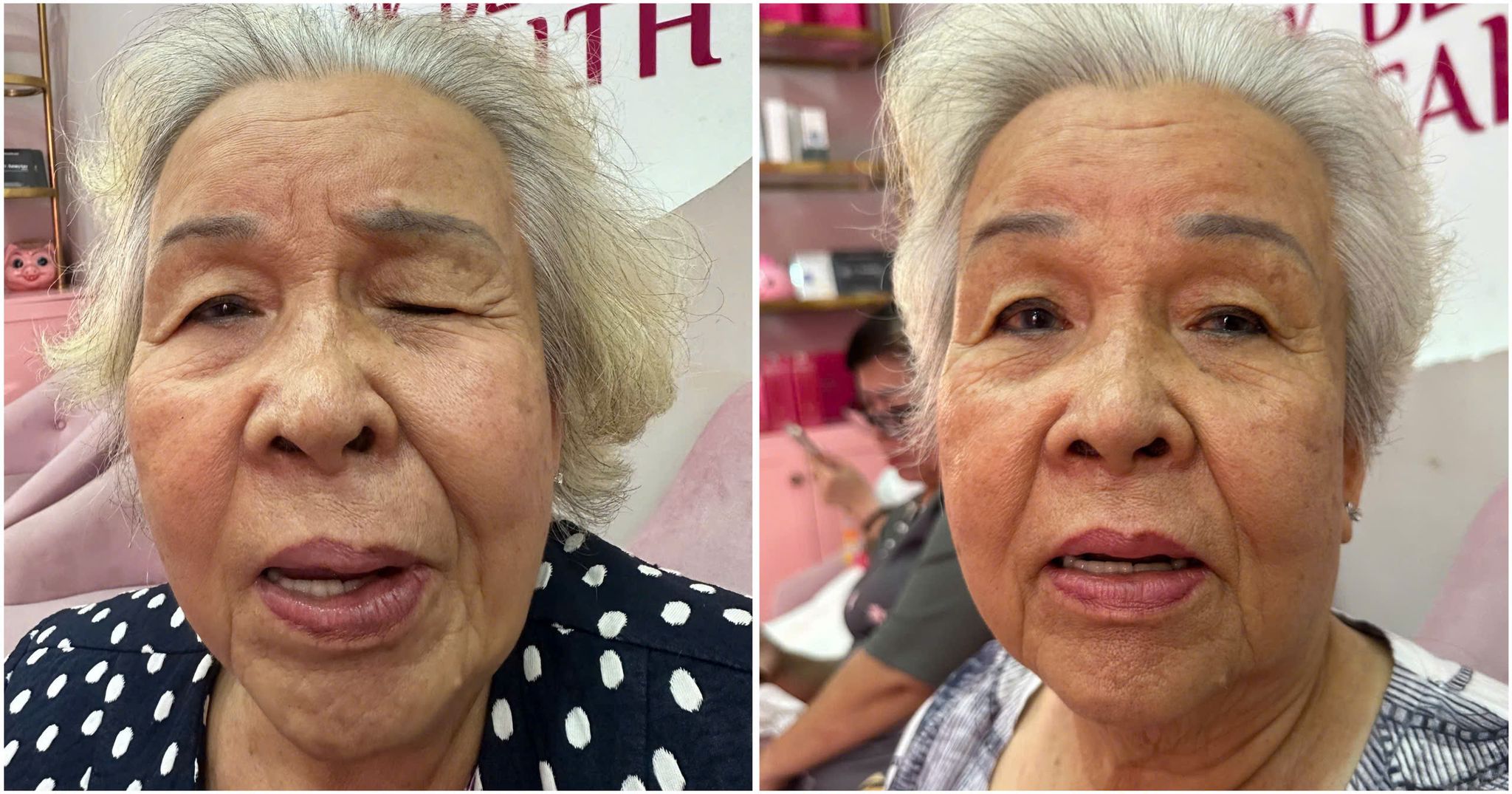 Trước & sau khi áp dụng phương pháp Face Reset